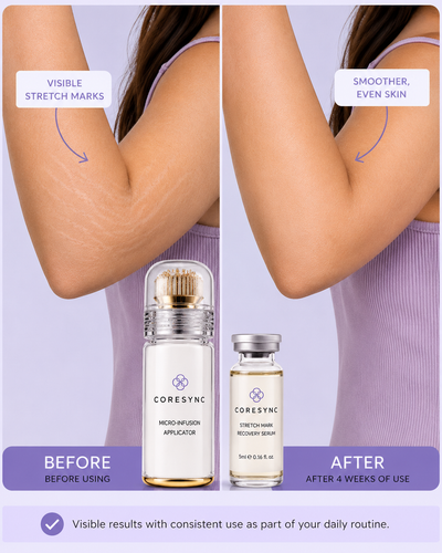 Coresync™ Micro-Infusion Stretch Mark Recovery System